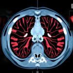 CT-vizsgálat Hounsfield-egységekkel, a szövetek azonosításához.