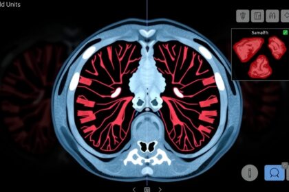 CT-vizsgálat Hounsfield-egységekkel, a szövetek azonosításához.